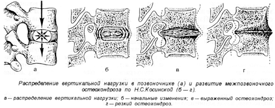 смертельные диеты анорексия